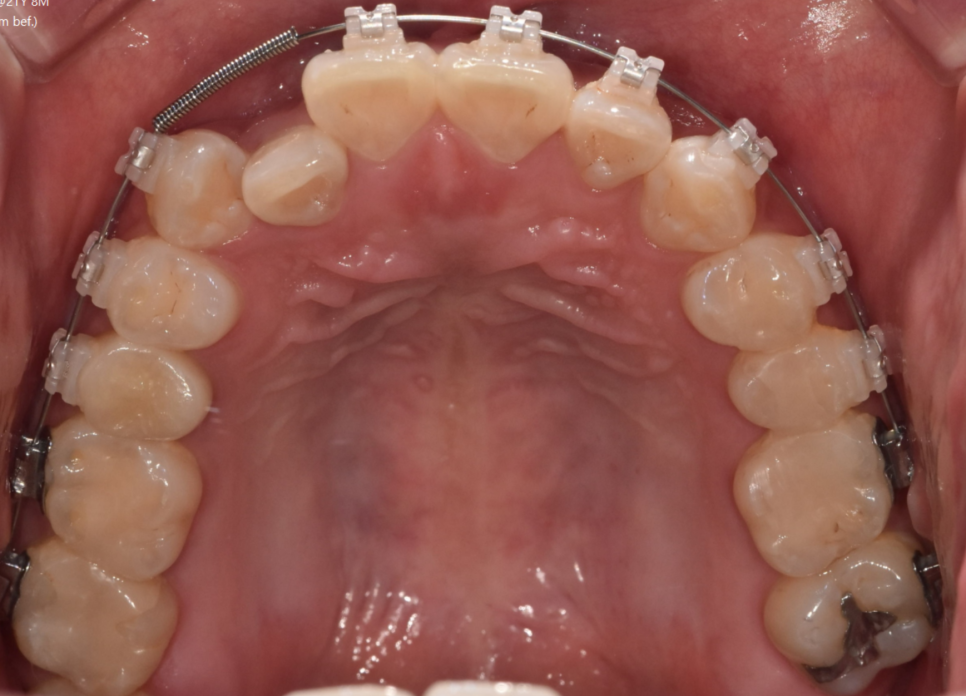 Are There Any Side Effects of Interproximal Reduction During Orthodontic Treatment? Click Here If You’re Concerned image 4