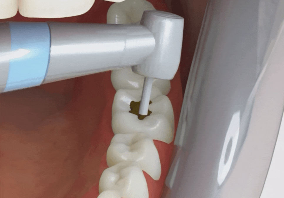 강동구 앞니 충치, 누구는 레진이고 누구는 임플란트인 관련 이미지 12