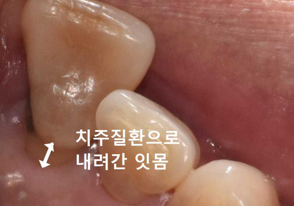 대문니 빠짐, 앞니 빠졌을 때 브릿지와 임플란트 중 나에게 맞는 선택은? 관련 이미지 6