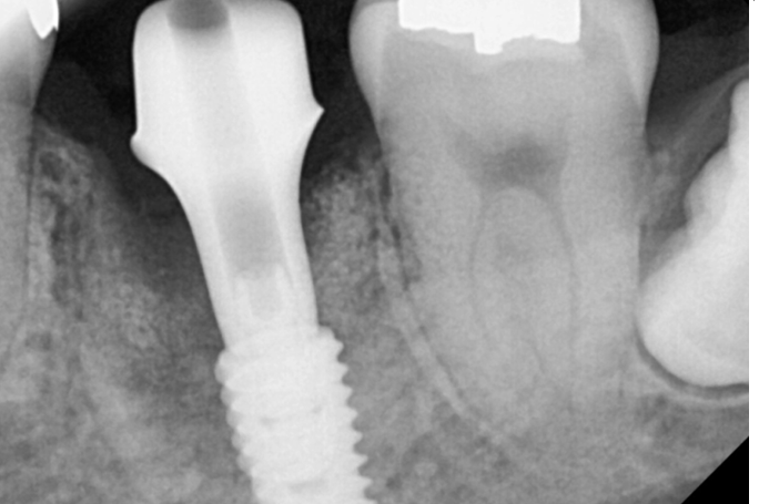 감일동 치과 첫번째 임플란트 시작이 중요합니다. 관련 이미지 9