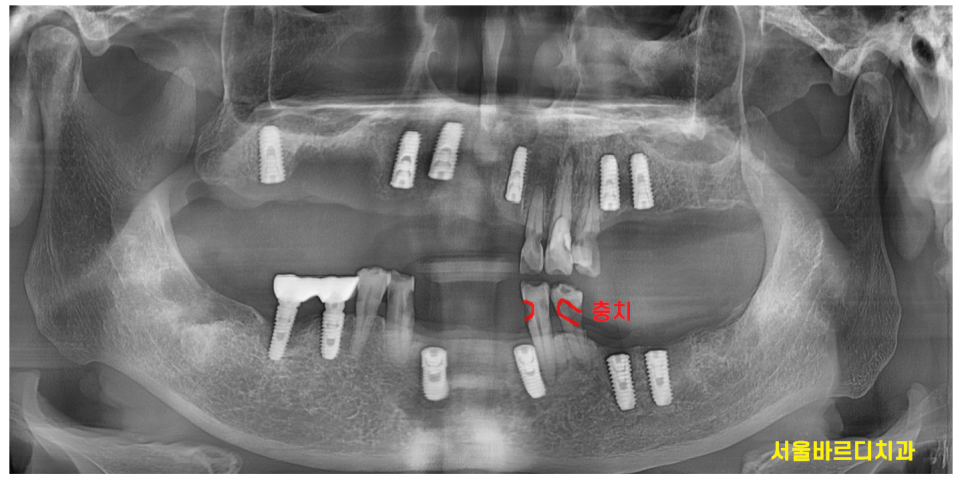 천호동 치과 자연 발치 후 방치된 치아 임플란트 케이스 관련 이미지 8