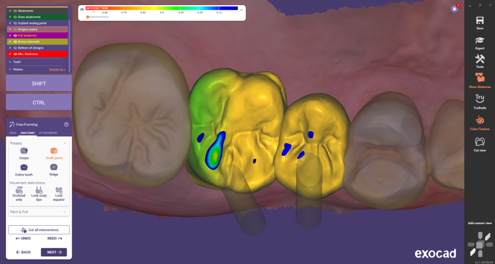 상일동 임플란트 상악동 거상술을 동반한 수술 증례 관련 이미지 15