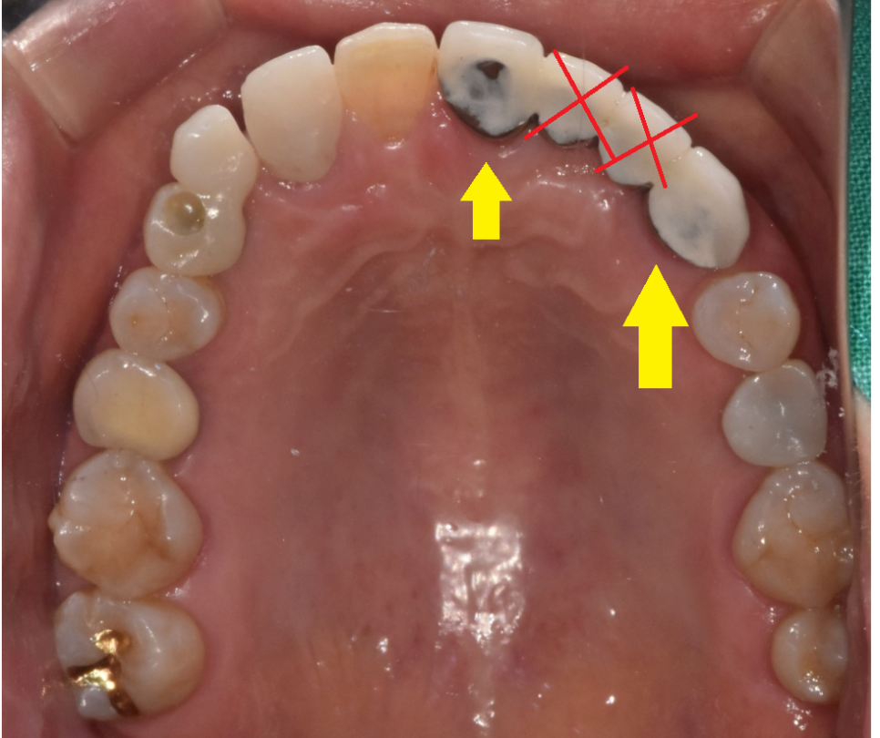길동 치과 임플란트 수술 대안은 없을까요???? 관련 이미지 3