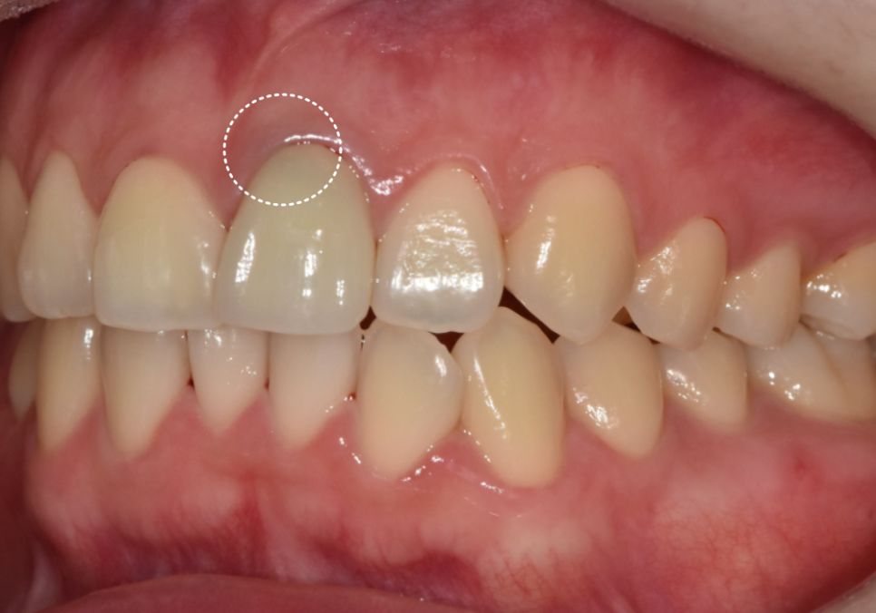 명일동 치과, 잇몸이 검게 변했다면? 앞니 변색 원인은 바로 관련 이미지 9