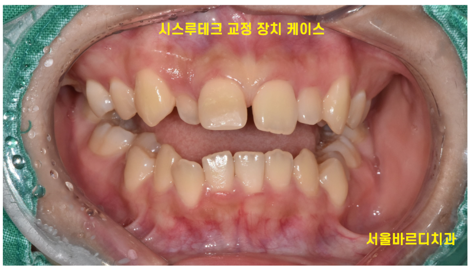 투명교정 장치 종류 인비절라인과 시스루테크 어느 것이 좋을까요? 관련 이미지 4