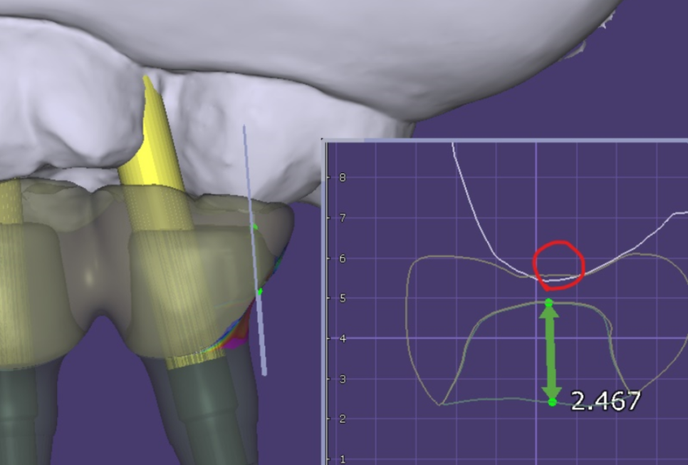 망월동 치과 임플란트 보철 불편 볼 씹힘, 이질감 그 사이에서 관련 이미지 6