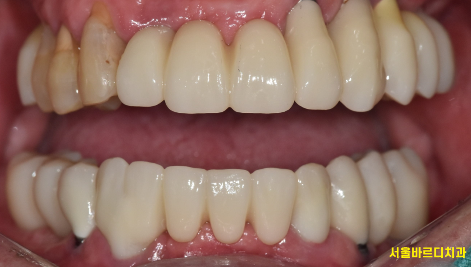 앞니 어금니 임플란트 동시에 진행할때 순서는? 관련 이미지 5