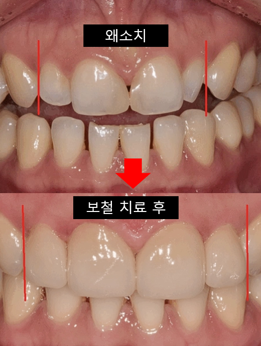 Microdontia Orthodontics Can Restore Balance and Alignment of the Teeth. image 3