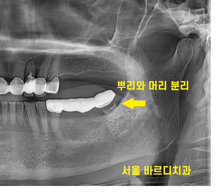 미사역 치과 건강보험 임플란트 혜택이 가능한 병원입니다. 관련 이미지 6