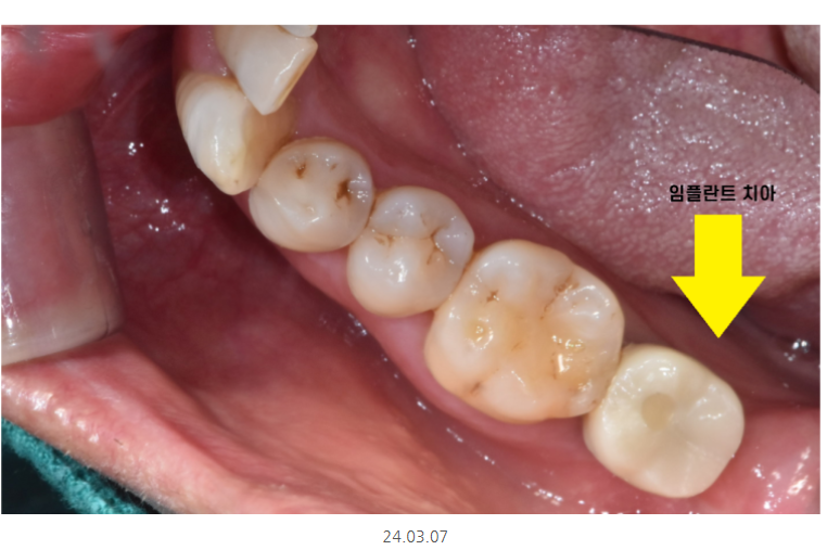 하남시청치과 내비게이션 임플란트 뭐가 좋아요?? 관련 이미지 10