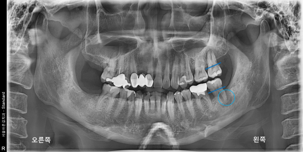 상일동치과 서울바르디치과 무절개 네비게이션 임플란트 치료증례 #7 관련 이미지 2