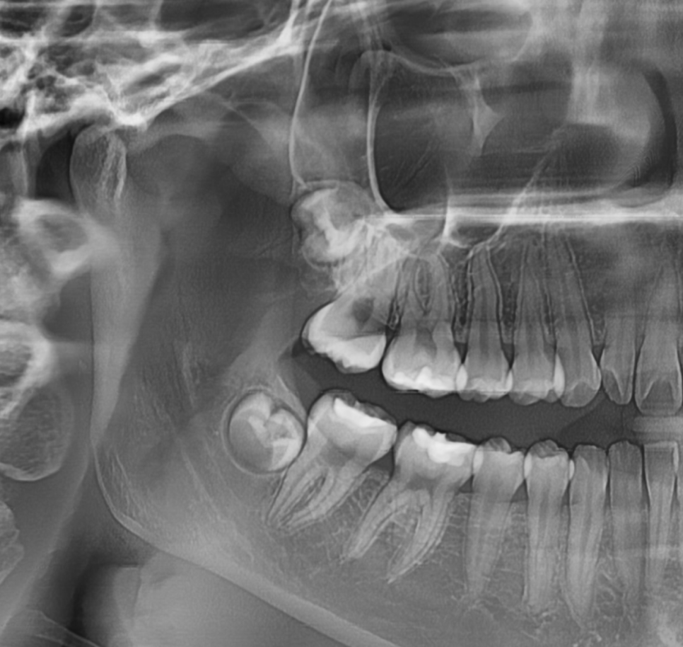 Gangdong-gu Orthodontic Dentistry: I Heard Orthodontic Treatment Causes Tooth Roots to Dissolve? image 1