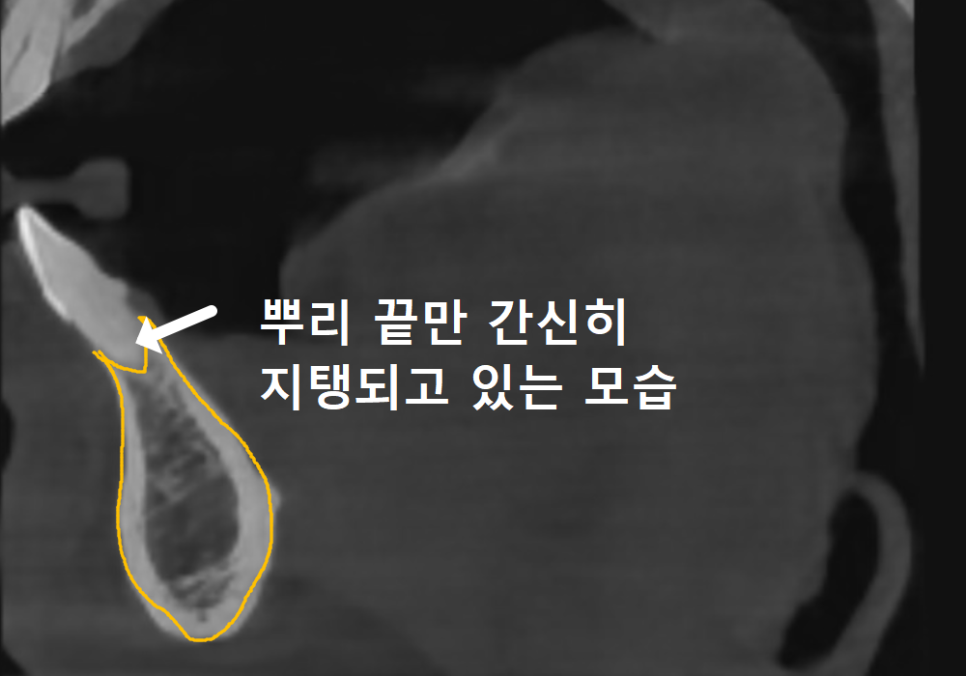 고덕동 아래 앞니 임플란트 비용 줄이는 비법, 공개합니다. 관련 이미지 7