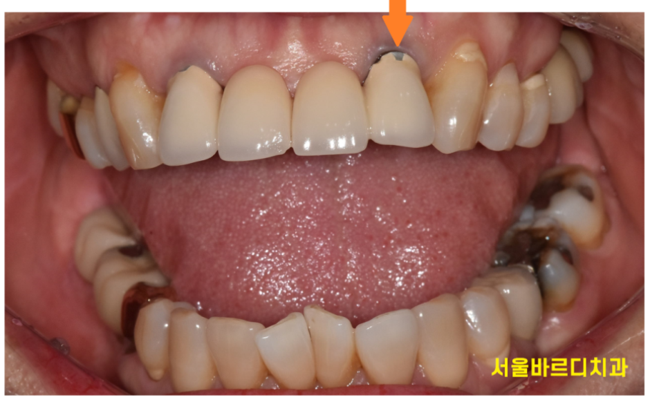 건강보험 임플란트 지르코니아 크라운 확대 길동 치과에서! 관련 이미지 3