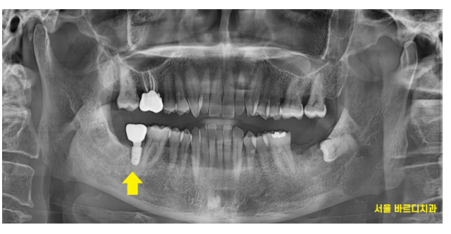 하남시청치과 내비게이션 임플란트 왜 좋다는거죠? 관련 이미지 9
