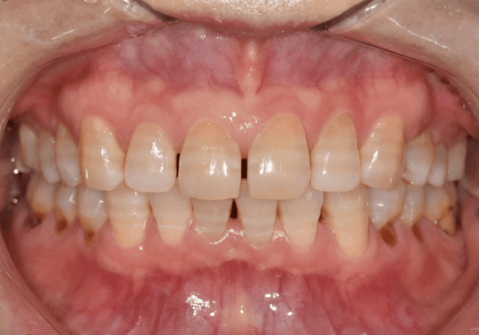 50대 라미네이트, 앞니 벌어짐과 변색 고민 이렇게 해결했습니다. 관련 이미지 2
