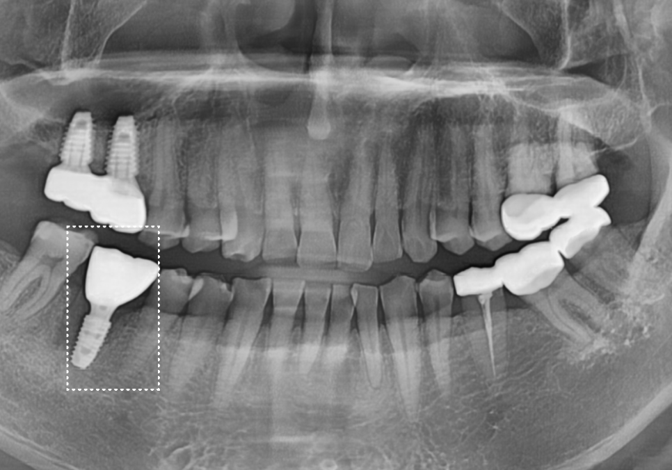 강동구 잇몸 여드름, 이런 상태라면 절대 겉에만 짜는 치료 하지 마세요. 관련 이미지 10