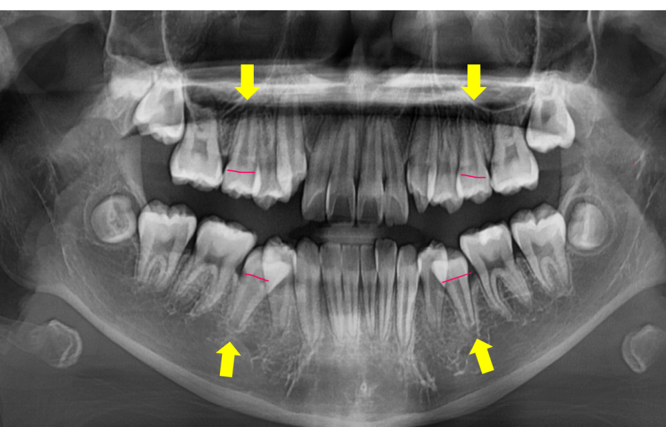How to Correct a Canine Crowding Malocclusion: Extractions Are Necessary to Address Lip Protrusion image 8