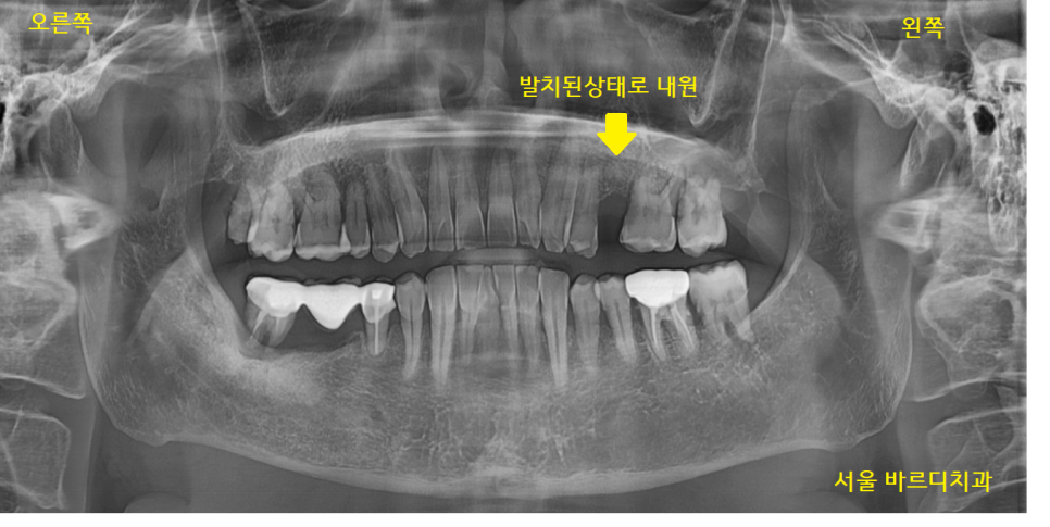 덕풍동 치과 임플란트 불가 판정받으신 환자분 살렸습니다. 관련 이미지 2