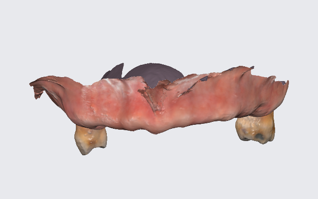 강동구 임플란트 어금니 상실 방치하다 치매까지 옵니다. 관련 이미지 11