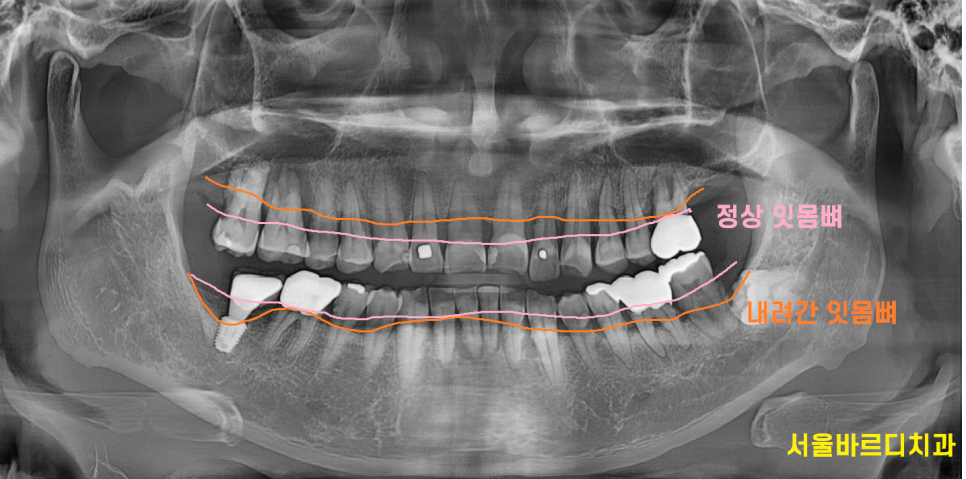 고덕 치과 잇몸 무너짐 천천히 진행되어서 더 무섭다. 관련 이미지 2