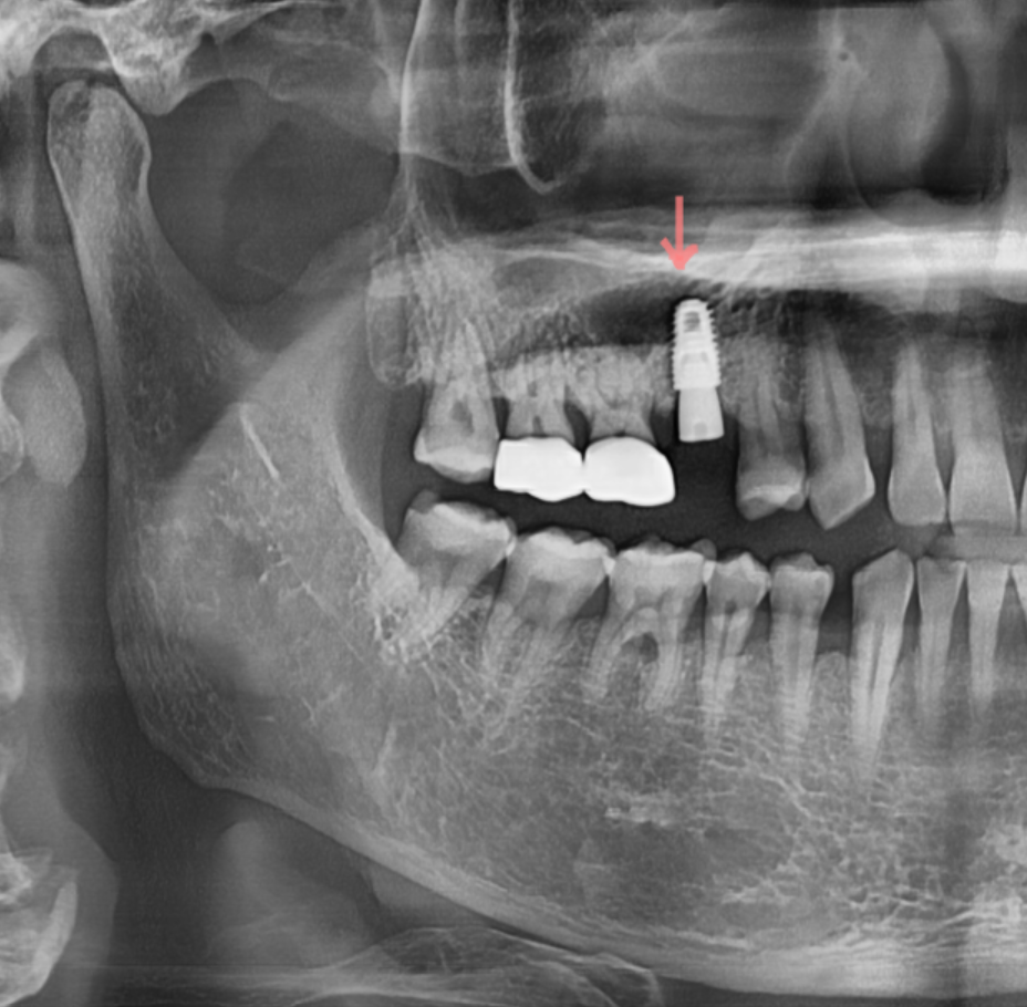 치아 상실 치료 치과 브릿지? 임플란트? 무엇이든 시도하세요. 관련 이미지 8