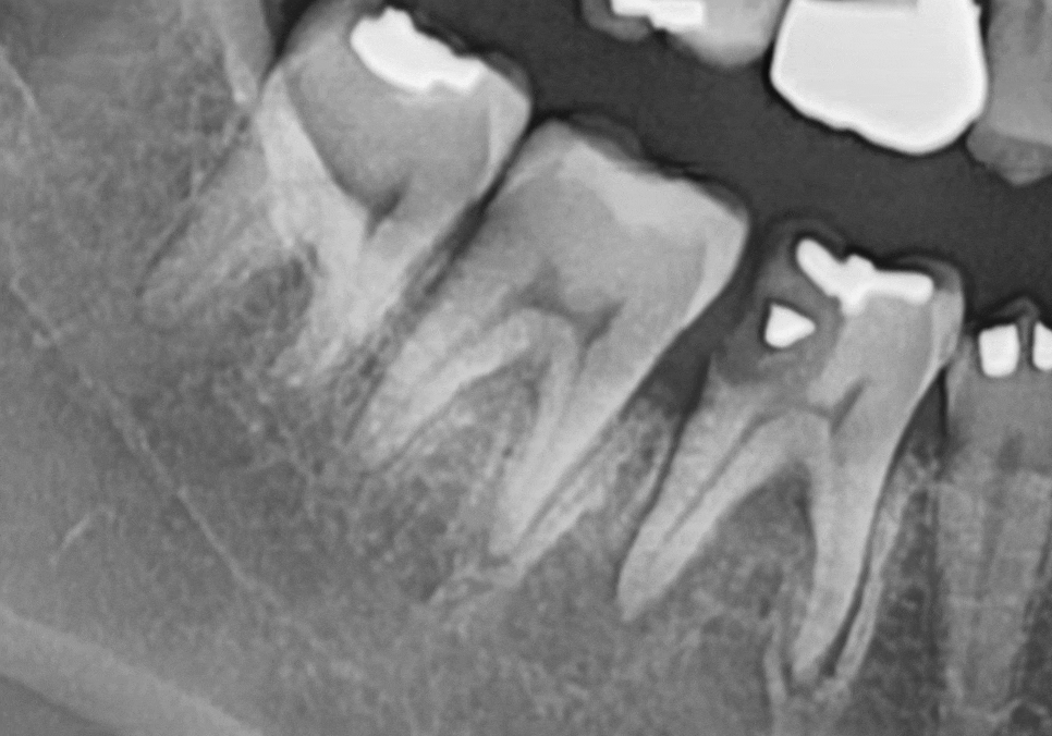 고덕동 어금니 사이 충치, 양치질 누구보다 열심히 하는데 왜 자꾸 생길까요? 관련 이미지 16