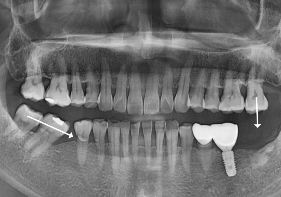 발치 후 빈 공간, 이 빼고 오래 냅두면 이렇게 됩니다. 관련 이미지 1