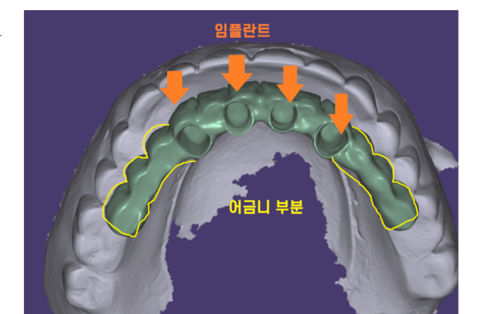 올온포 치아가 다 없어도 임플란트 4개만으로 복원이 가능합니다 관련 이미지 4