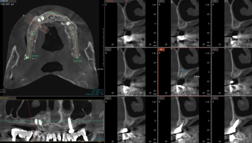 상일동 치과 부분 틀니에서 임플란트 바꿔서 사용하기 관련 이미지 8