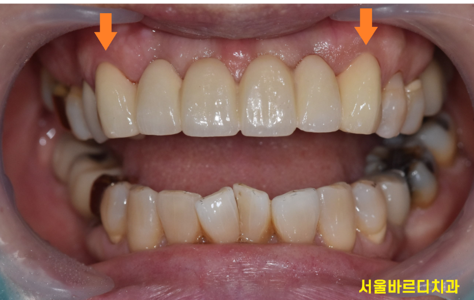 앞니 잇몸 검은색 라인 오래된 pfm 보철 교체하세요!! 관련 이미지 9