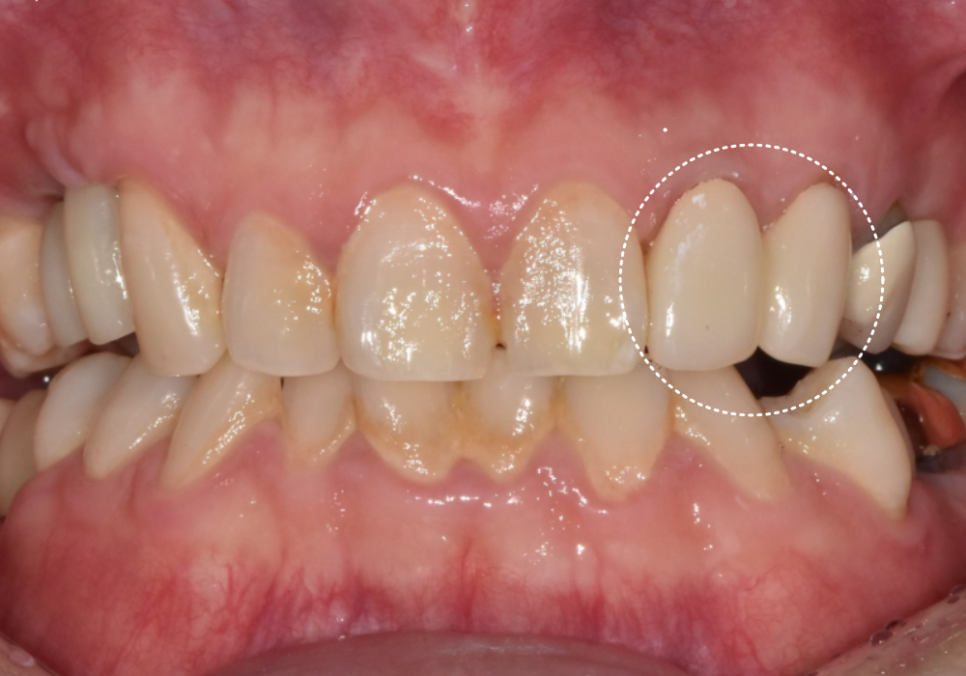 강동구 재신경치료, 왜 첫 치료보다 성공률이 낮다고 할까요? 관련 이미지 12
