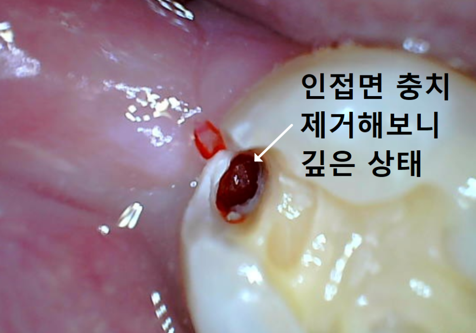 고덕동 사랑니 매복 발치, 안 아픈데 꼭 빼야 하나요? 관련 이미지 11