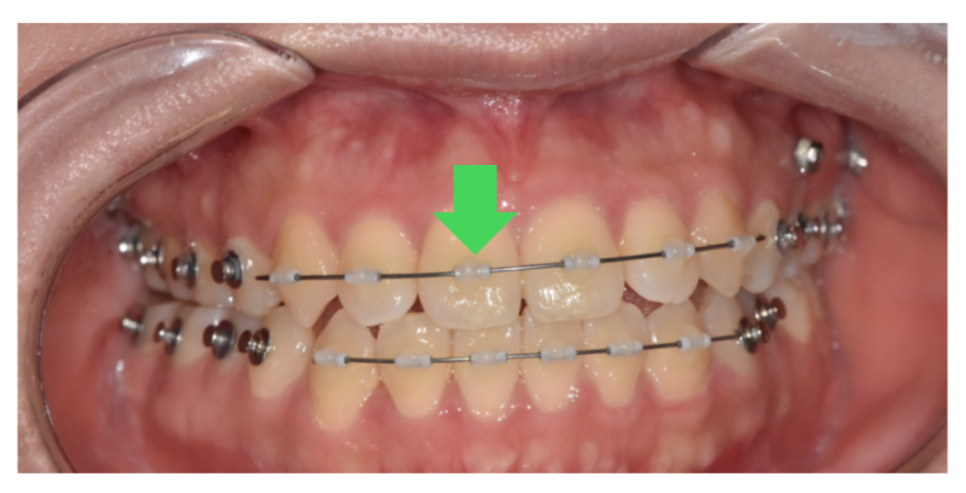 mta 장치 교정 앞니만 빠르게 심미적으로 정리할 수 있습니다. 관련 이미지 2