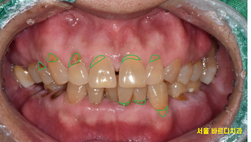 망월동 치과 어금니 빠짐 임플란트 대안이 될 수 있습니다. 관련 이미지 8