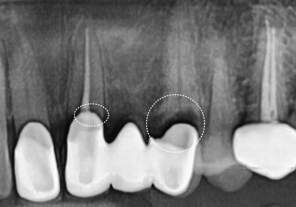 오래된 앞니 크라운 냄새, 관련 이미지 2