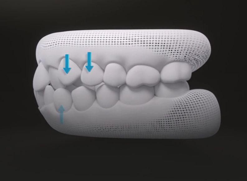 투명교정 치료 과정 이렇게 진행됩니다! 집에서 장치를 받아요! 관련 이미지 5