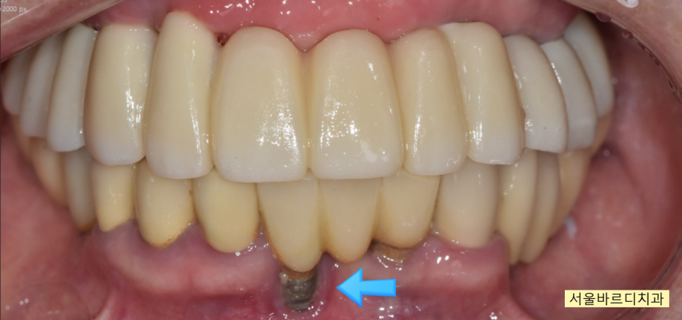 상일동 치과 부분 틀니에서 임플란트 바꿔서 사용하기 관련 이미지 12