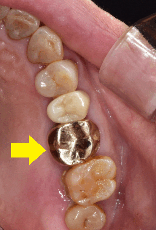 감일동 치과 어금니 시림 충치가 아닐 수도 있다? 임플란트 하게된 사연 관련 이미지 1