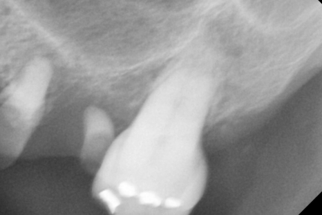 강동구 임플란트 어금니 상실 방치하다 치매까지 옵니다. 관련 이미지 6