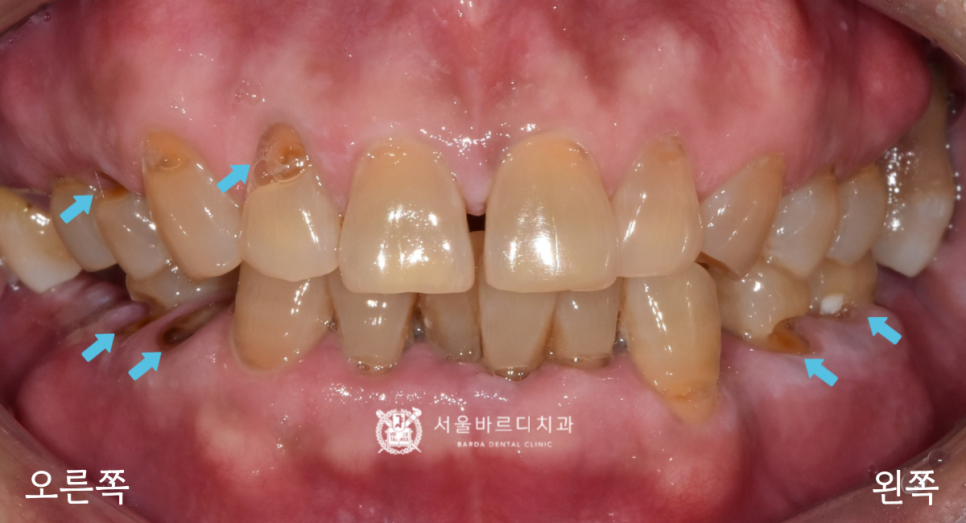 고덕동치과 서울바르디치과 무절개 네비게이션 임플란트 치료증례 #1 관련 이미지 2