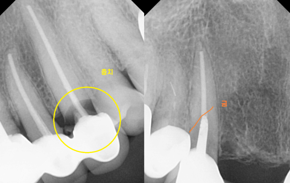 하남미사치과 앞니 브릿지를 임플란트로 교체했습니다. 관련 이미지 4