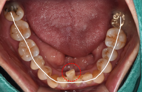 솟구치는 앞니, 흔들리는 치아가 보내는 관련 이미지 7