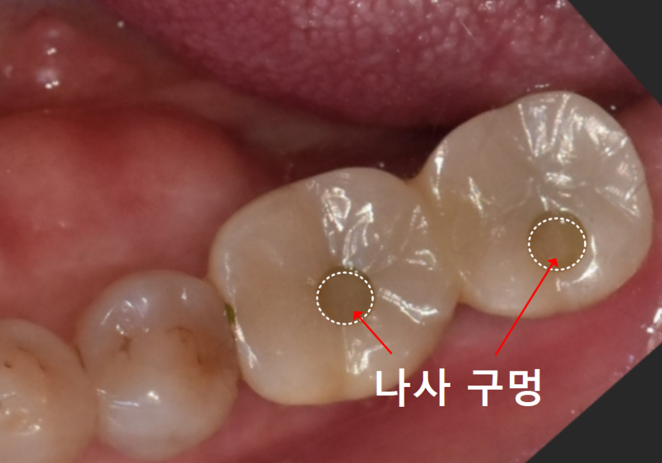 임플란트 움직임, 관련 이미지 4