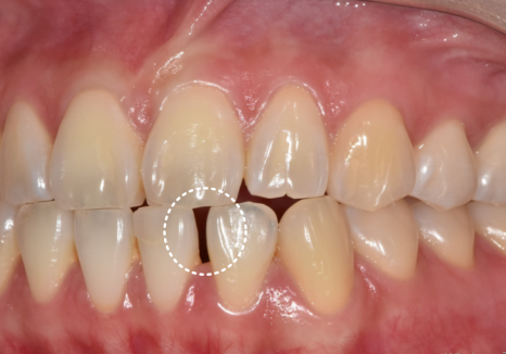 앞니 라미네이트, 치아 시림 고민 덜 수 있는 해결 방법 공개합니다. 관련 이미지 7