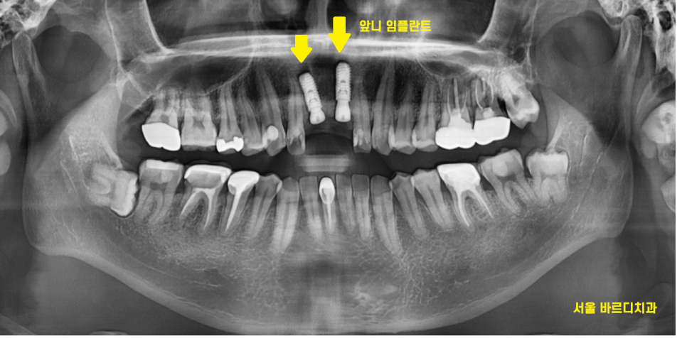 앞니 부러짐 손상이 커서 하남선동치과에서 임플란트 치료 관련 이미지 9