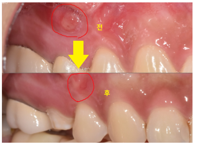 망월동 치과 재신경치료 자연치아 살리기 끝판왕 치료 mta로 가능했습니다. 관련 이미지 9