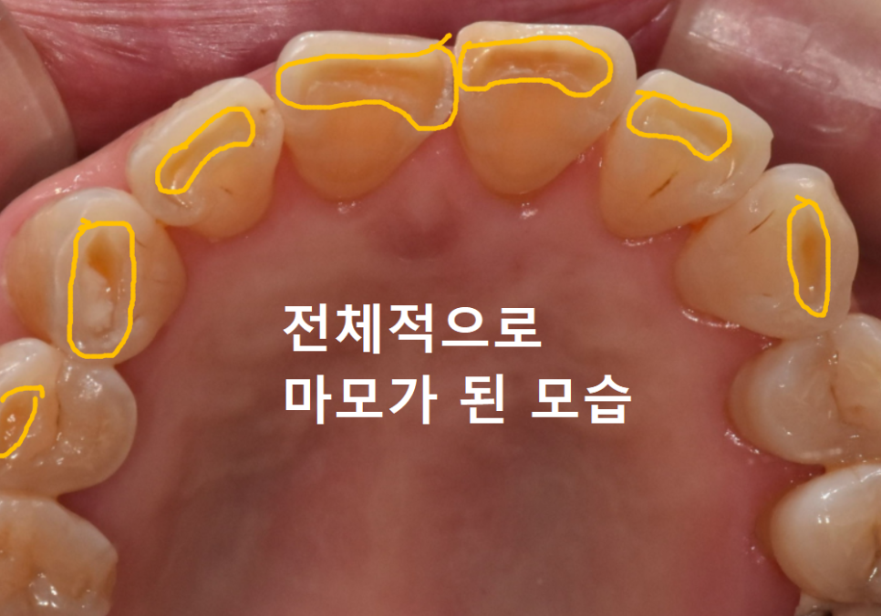 앞니 끝부분 깨짐, 다듬기, 레진, 라미네이트? 어떤 치료가 나에게 적합할까? 관련 이미지 5