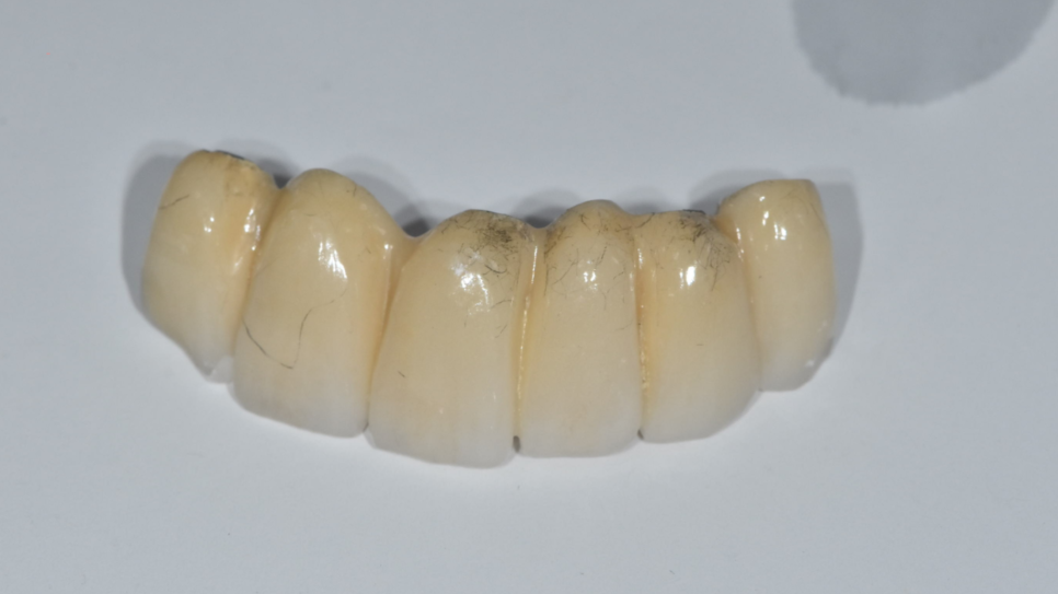 임플란트 대체 수술이 부담스러울 때는 브릿지 치료 관련 이미지 2