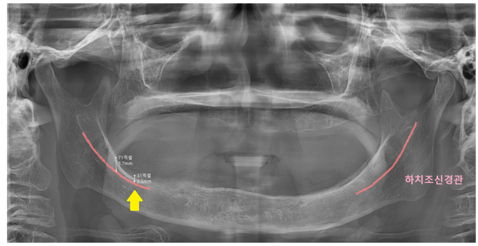 임플란트 불가능한 경우 3가지 경우는? 관련 이미지 3